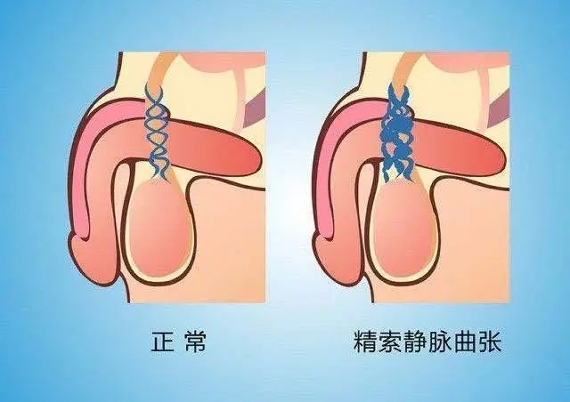 蛋疼……小心是患上这种影响生育的疾病